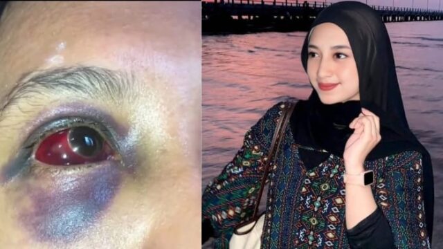 RJ alias Puput (24) menjadi korban KDRT suaminya